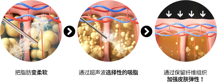 3D CT FIT 얼굴지방흡입